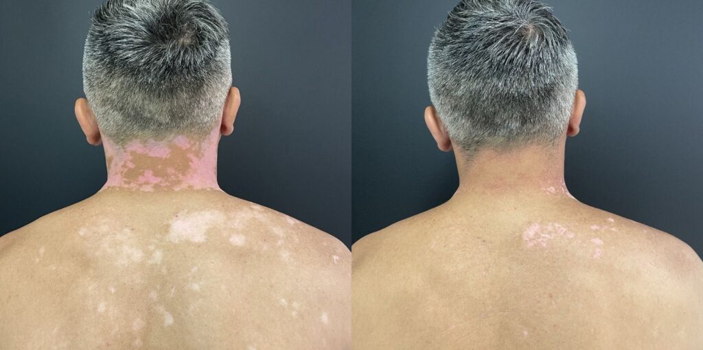 Vitiligo: conheça a história de seu Francisco e entenda melhor a doença com a médica especialista nesse tratamento 3 IMG 20240424 WA0214